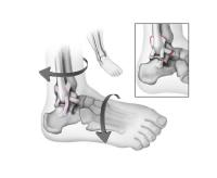 Diagram of ankle sprain mechanics